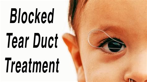 tear drainage test|clogged tear duct infant surgery.